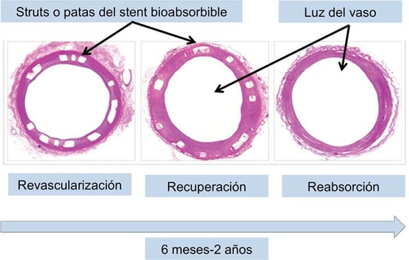 2014 01 03 cortes transversales de arteria coronaria tratada con stent bioabsorbible (2)