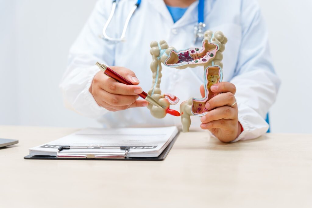 Síntomas del cáncer de colón