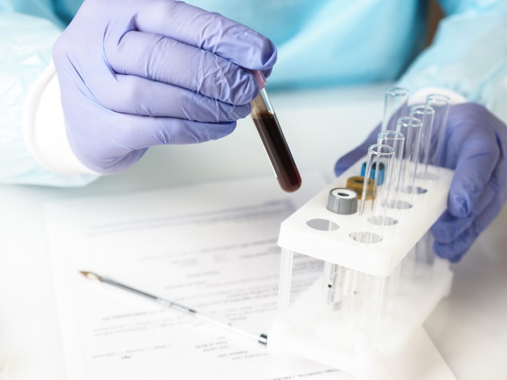 ¿En qué consiste la prueba del antígeno prostático específico?