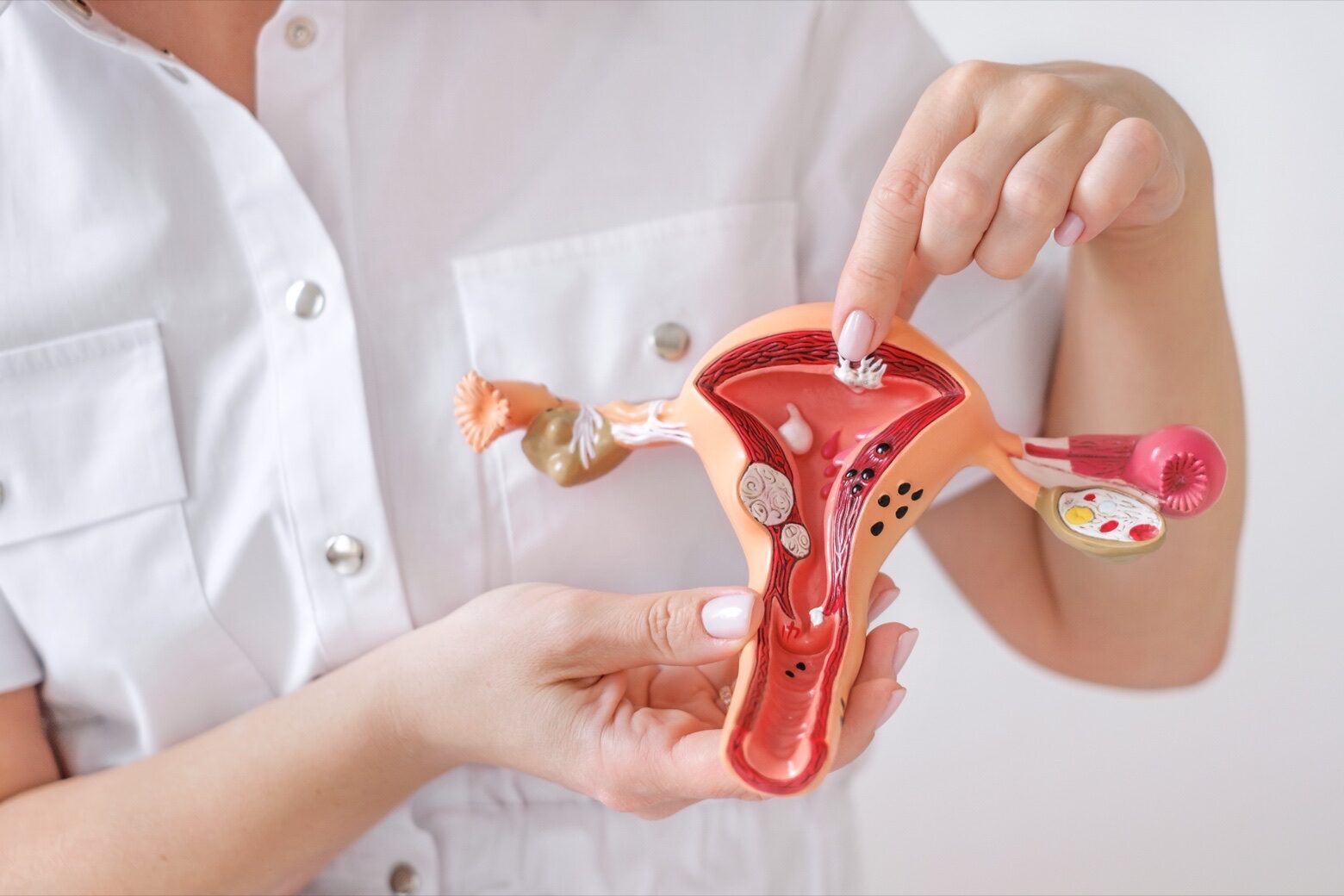 Imagen para: ¿Qué son los miomas y cuáles son sus síntomas?