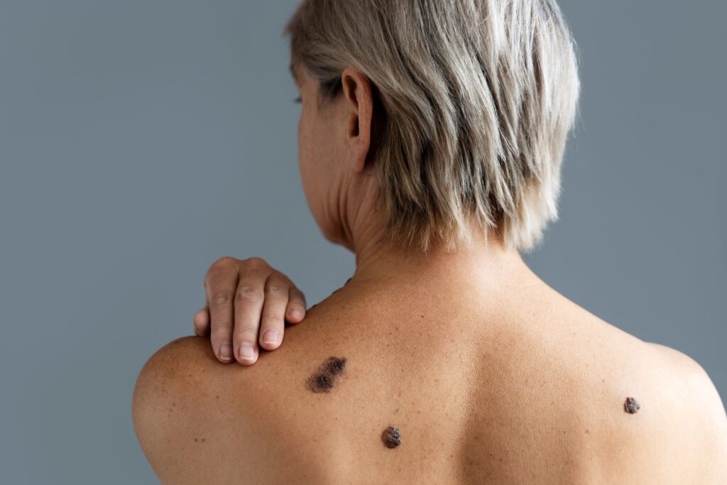 Espalda con marcas en la piel. Melanoma: causas, síntomas y tratamiento