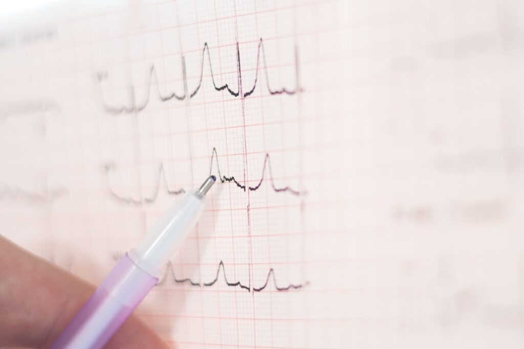 Como interpretar electrocardiograma imagen2