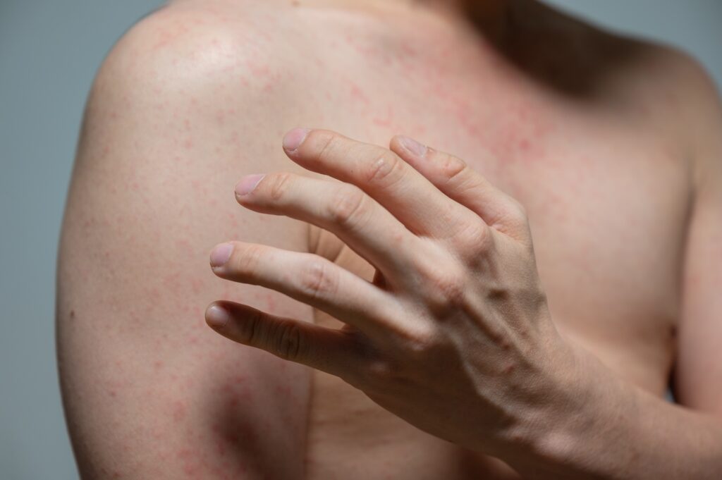 Descubre cómo tratar y prevenir la dermatitis del nadador