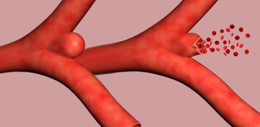 Aneurisma, dilatación anormal de una arteria