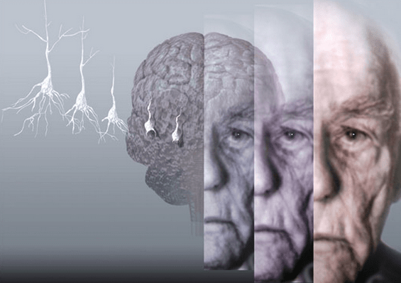 Imagen para: Enfermedades Neurodegenerativas ¿Qué son?