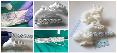 HM Montepríncipe interviene con éxito un aneurisma de arco aórtico con ayuda de impresión 3D por primera vez en España