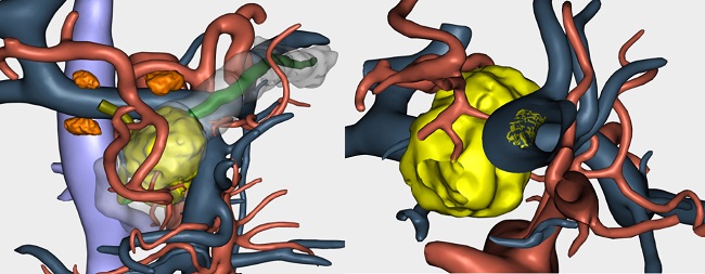 La Unidad de Cirugía General y Digestiva del Hospital Universitario HM Sanchinarro lidera la personalización de la cirugía oncológica a nivel mundial