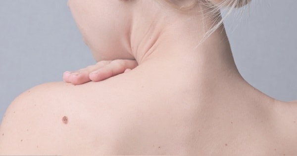 La prevención se mantiene como principal arma para evitar los procesos oncológicos de la piel