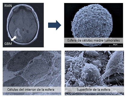 La revista “oncotarget” publica un estudio sobre creación de copias artificiales de glioblastomas multiformes a partir de células madre tumorales