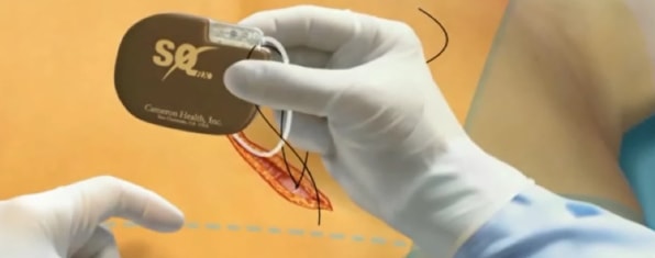 Imagen para: HM Hospitales adquiere el desfibrilador automático implantable subcutáneo (DAI-SC) de la empresa Boston Scientific