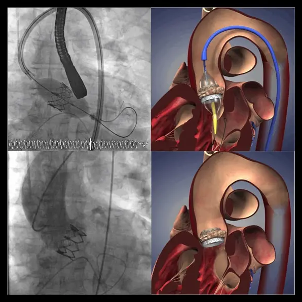 Imagen para: Realizados en el CIEC dos procedimientos consecutivos de implantación de válvula aórtica por prodecimientos percutáneos