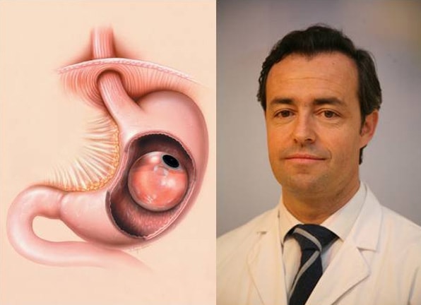 Imagen para: La Unidad de Tratamiento Endoscópico de la Obesidad de HMS realiza los primeros casos de abordaje del sobrepeso con Balón Intragástrico ingerible de España