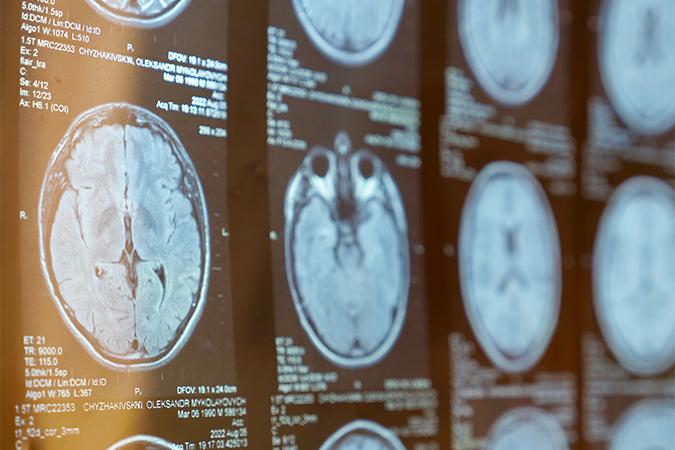 Diagnóstico por imagen de esclerosis múltiple