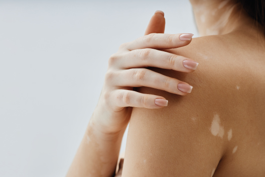 Mujer con machas blancas en la piel