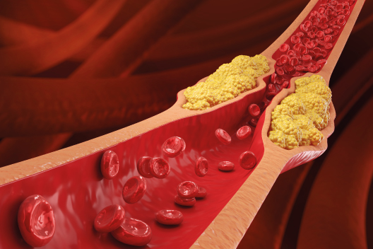 Arterias obstruidas por colesterol