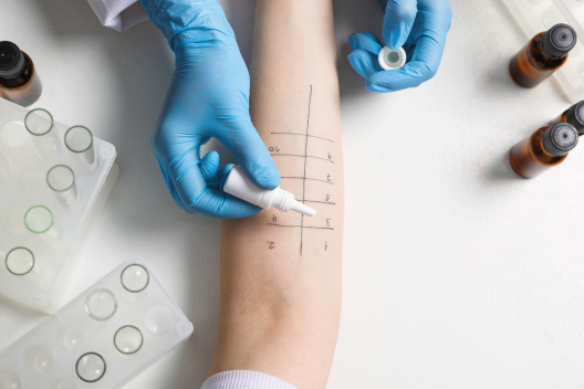 Paciente realizando pruebas de alergología