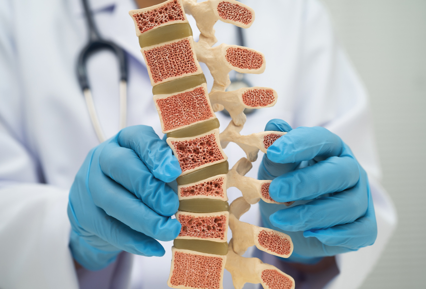 Imagen para: ¿Cómo frenar la osteoporosis?