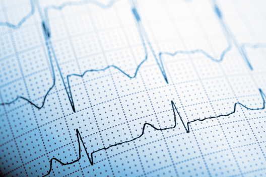 Registro de electrocardiograma (ECG) con ondas cardíacas impresas sobre cuadrícula médica