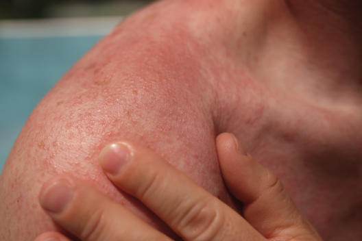 Urticaria en la piel provocada por exposición solar