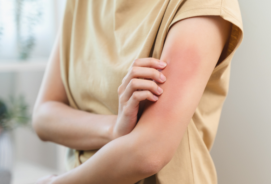 Imagen para: ¿Qué es la alergia al sol y cómo se trata? 