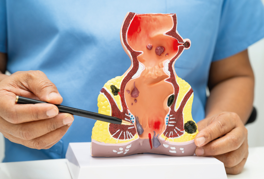 Doctor con una maqueta mostrando hemorroides