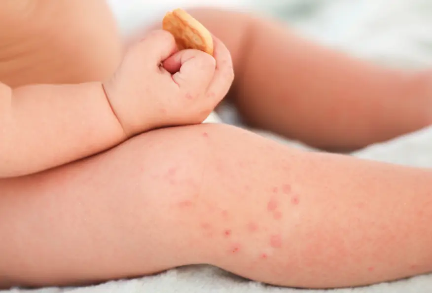 Imagen para: ¿Granitos por calor? Así es la sudamina y cómo puedes aliviarla 