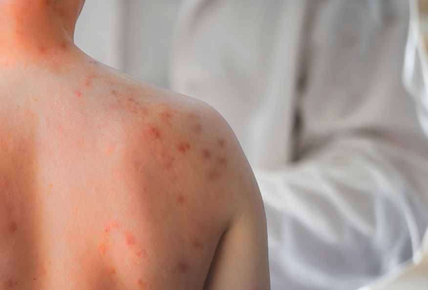 Imagen para: Fiebre y manchas rojas en la piel: ¿puede ser sarampión?