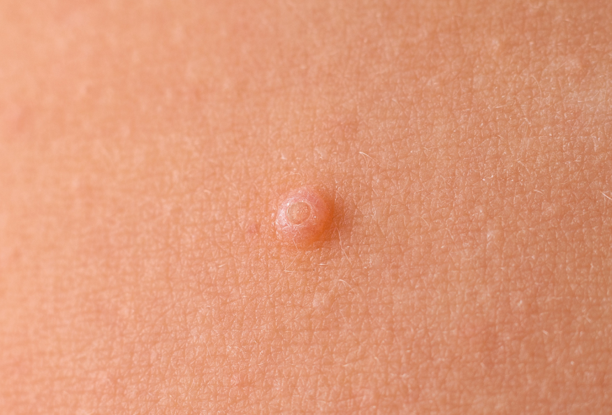 Pequeña protuberancia en la piel producida por moluscos