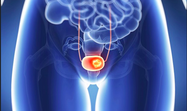 Imagen para: Innovation in Urothelial cancer