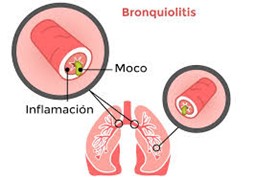 Imagen para: Bronquiolitis