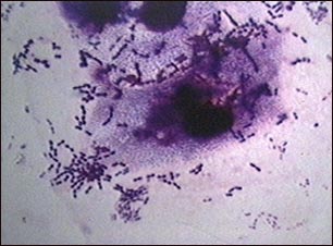 Imagen para: Vacuna contra el neumococo