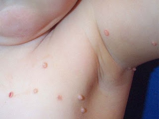 Imagen para: ¿Qué son estos granitos? Molluscum contagiosum