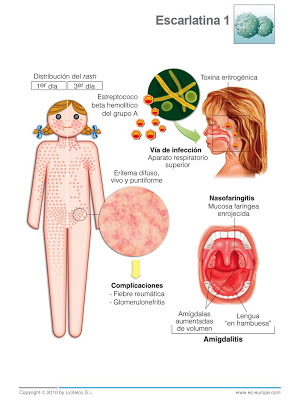 Imagen para: La escarlatina: ¿es una enfermedad grave?
