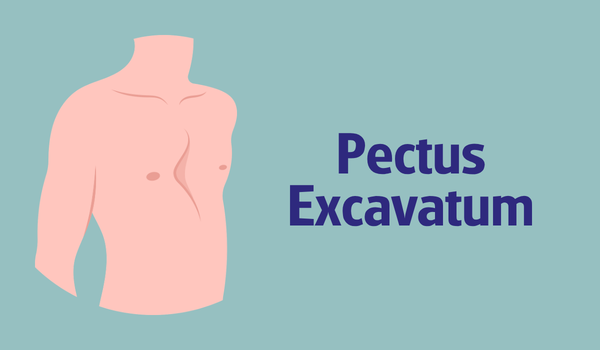 Imagen para: Pectus excavatum en niños: qué es, cómo detectarlo y cuándo se recomienda tratamiento
