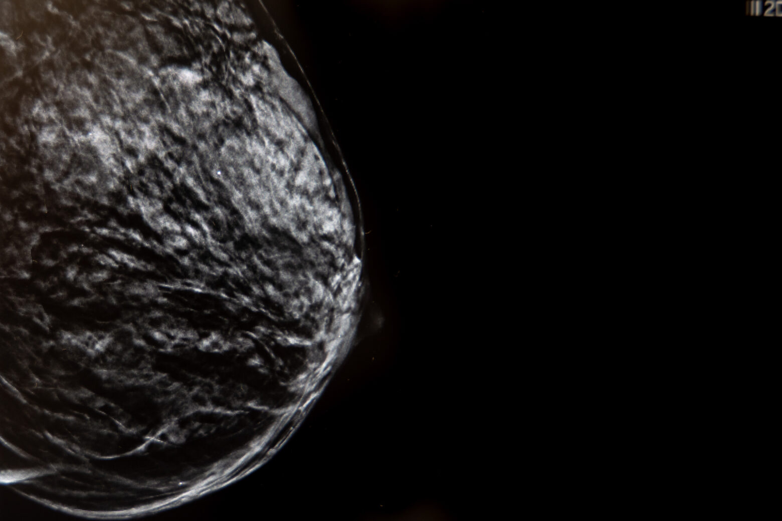 Imagen de una mamografía con tomosíntesis 2560x1707